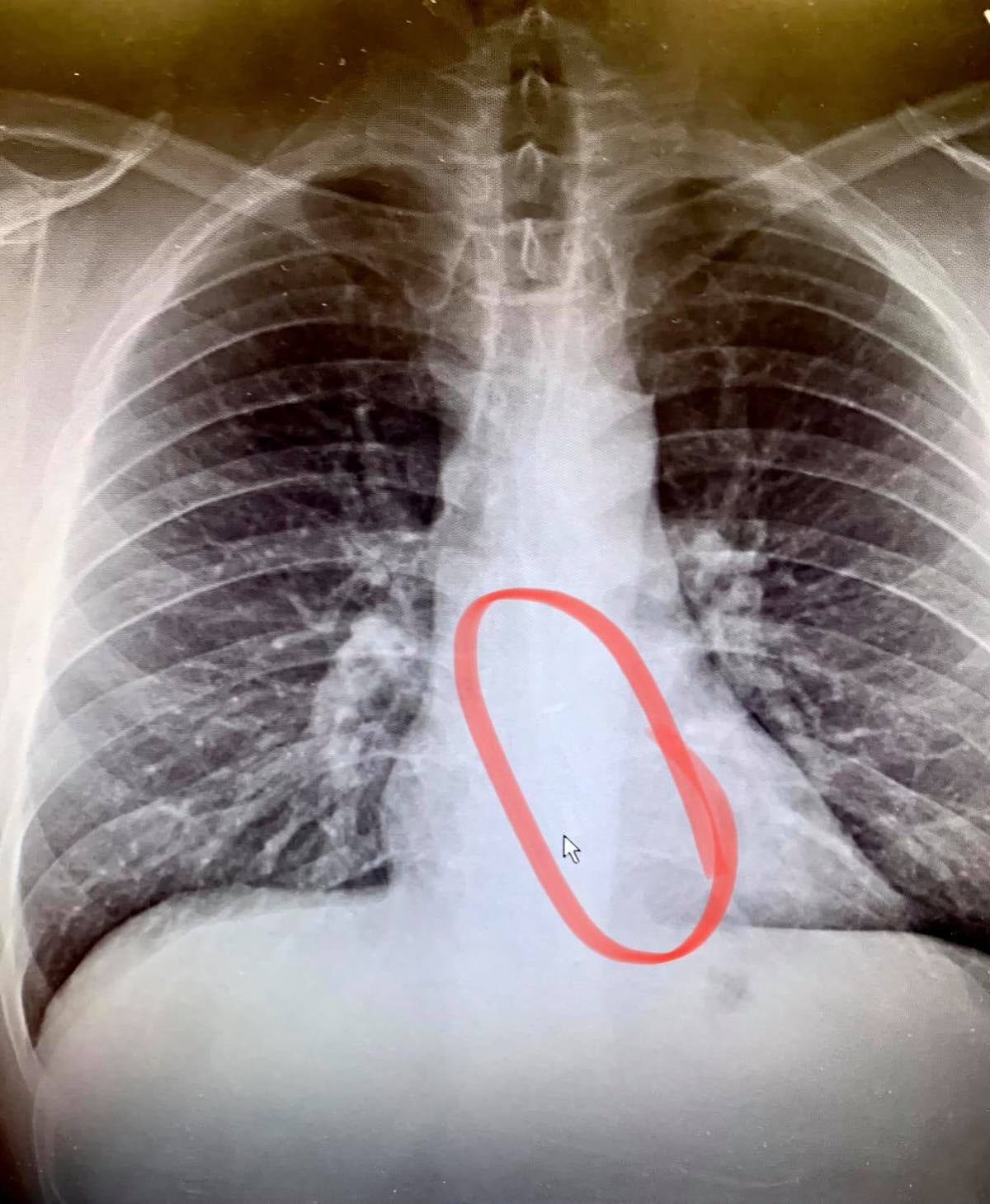 man had to undergo an endoscopy to remove the airpod from his esophagus which he swallowed while sleeping