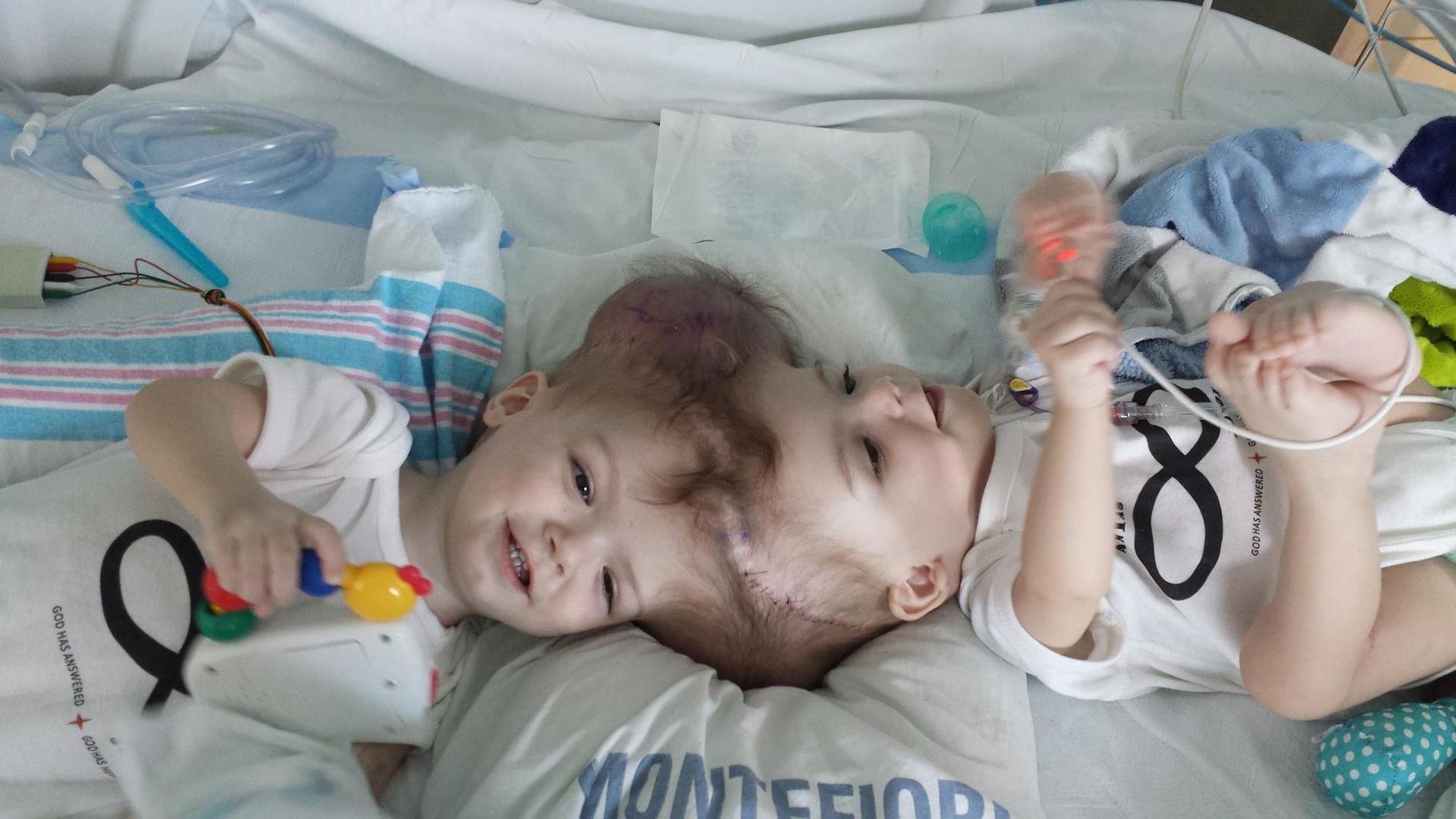 Twins Born With Conjoined Heads Finally Got Separated After 27 Hours Of Operation