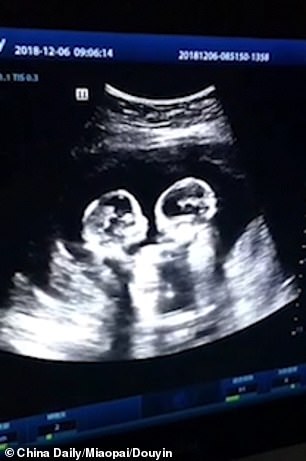 Identical Twins Found Fighting In The Mother's Womb During An Ultrasound Scan