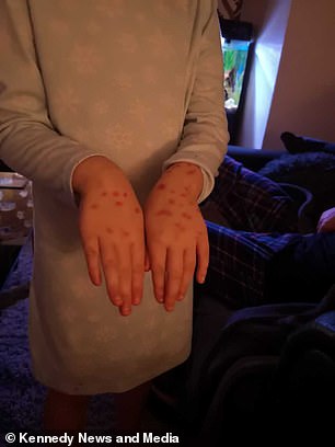 schoolgirl faked chickenpox to avoid school but it turned to be a permanent marker she used to draw spots