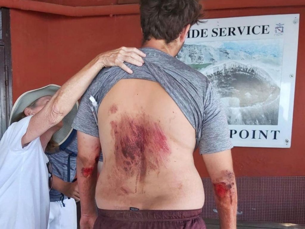 Tourist Injured After He Fell Into Mount Vesuvius While Taking A Selfie