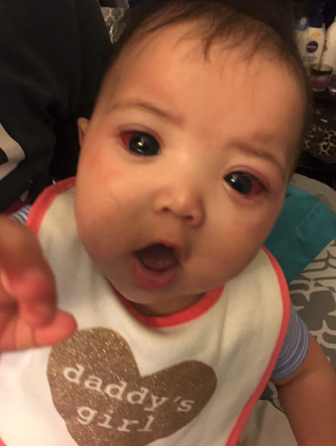 A Rare Genetic Condition Made This Little Girl's Eyes Look Big And Gorgeous