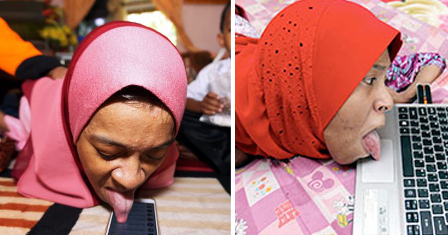 Disabled Girl Who Uses Her Smartphone and Laptop With Her Tongue