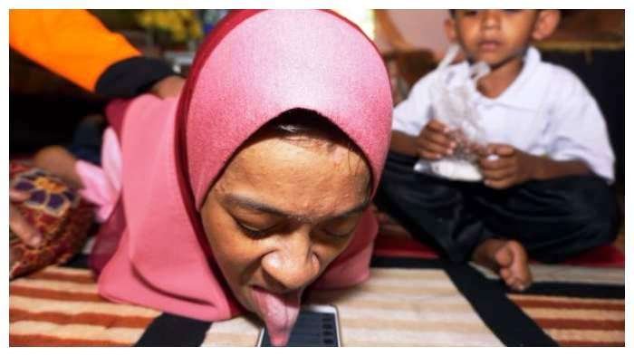 Disabled Girl Who Uses Her Smartphone and Laptop With Her Tongue