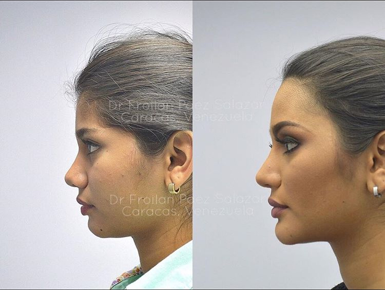 Before & After Surgery Photos Of Miss Venezuela Revealed By Her Surgeon