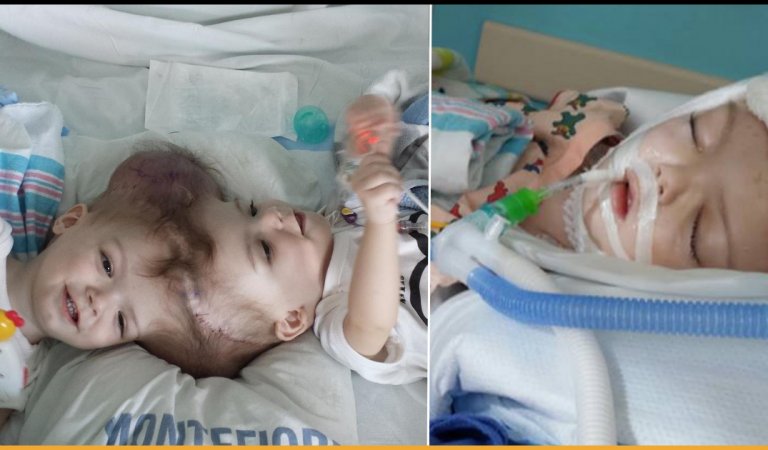 Twins Born With Conjoined Heads Finally Got Separated After 27 Hours Of Operation