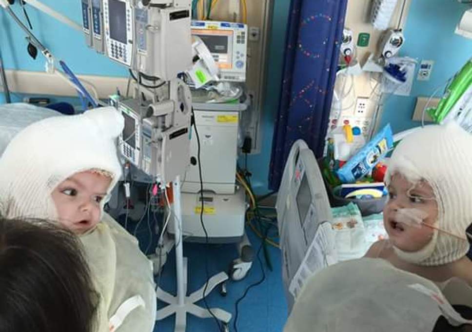 Twins Born With Conjoined Heads Finally Got Separated After 27 Hours Of Operation