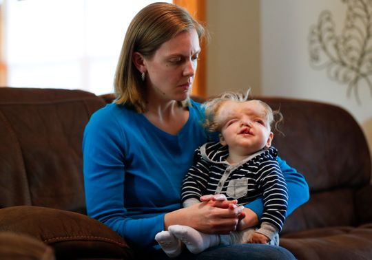 The Baby Who Took Birth Without A Skull Celebrates His First Birthday