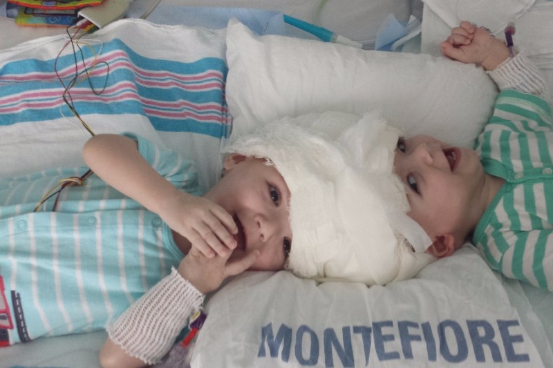 Twins Born With Conjoined Heads Finally Got Separated After 27 Hours Of Operation