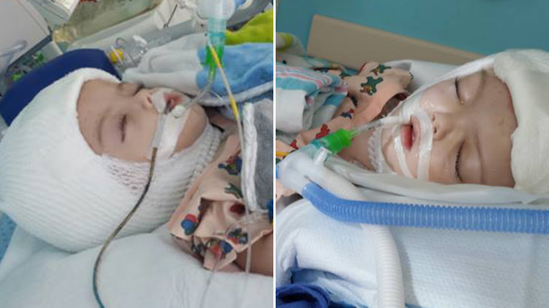 Twins Born With Conjoined Heads Finally Got Separated After 27 Hours Of Operation