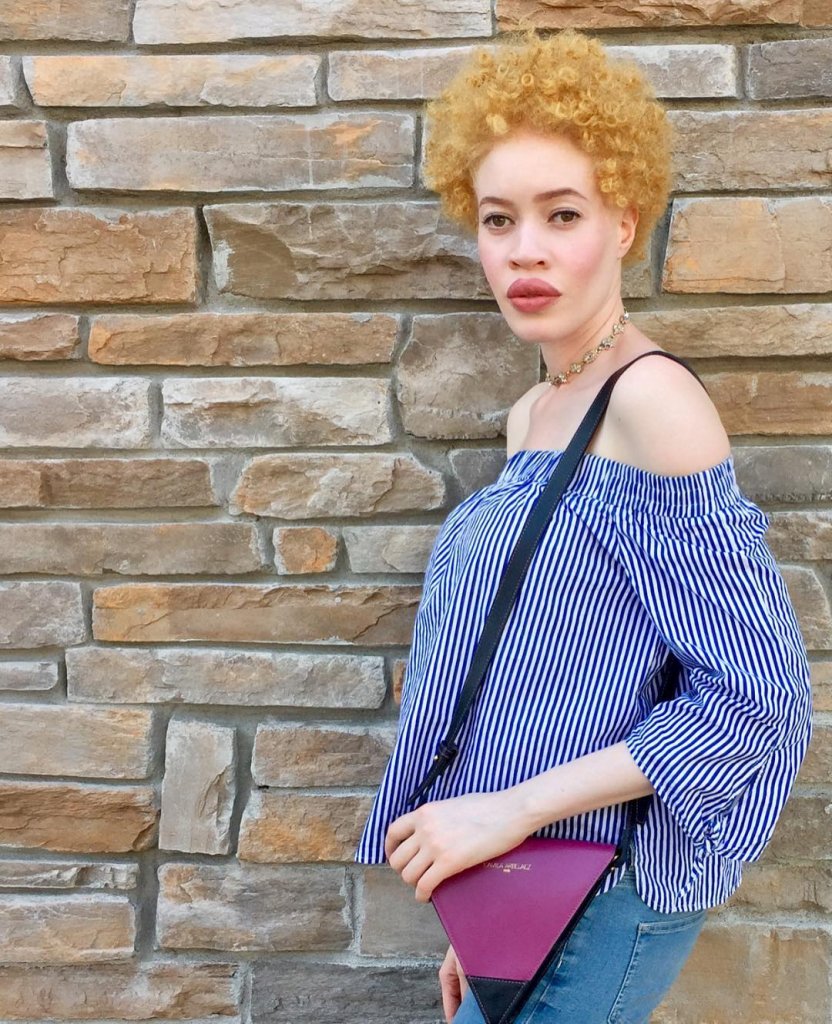 Meet The Albino African American Model Who Proves That Beauty Isn't Black And White
