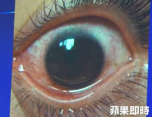 Woman Suffers From 500 Holes On Cornea After Always Using Phone On Max Brightness