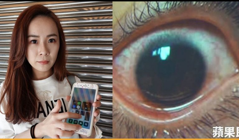 Woman Suffers From 500 Holes On Cornea After Always Using Phone On Max Brightness