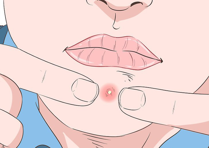 Here's Why You Need To Stop Popping Your Pimples Right Away