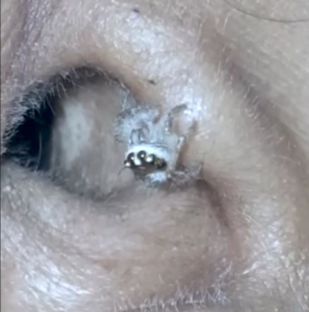 Woman Found That A Spider Living In Her Ear Is The Reason Behind Her Headaches
