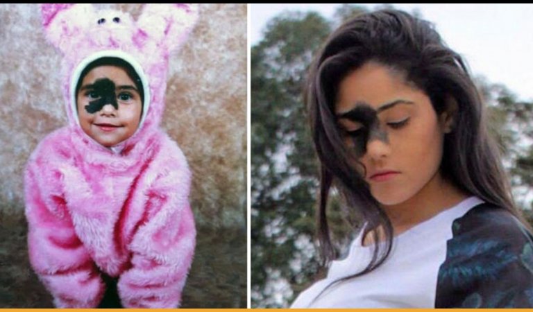 Brazilian Girl Decided Not To Remove Birthmark Even After She Faced Criticism
