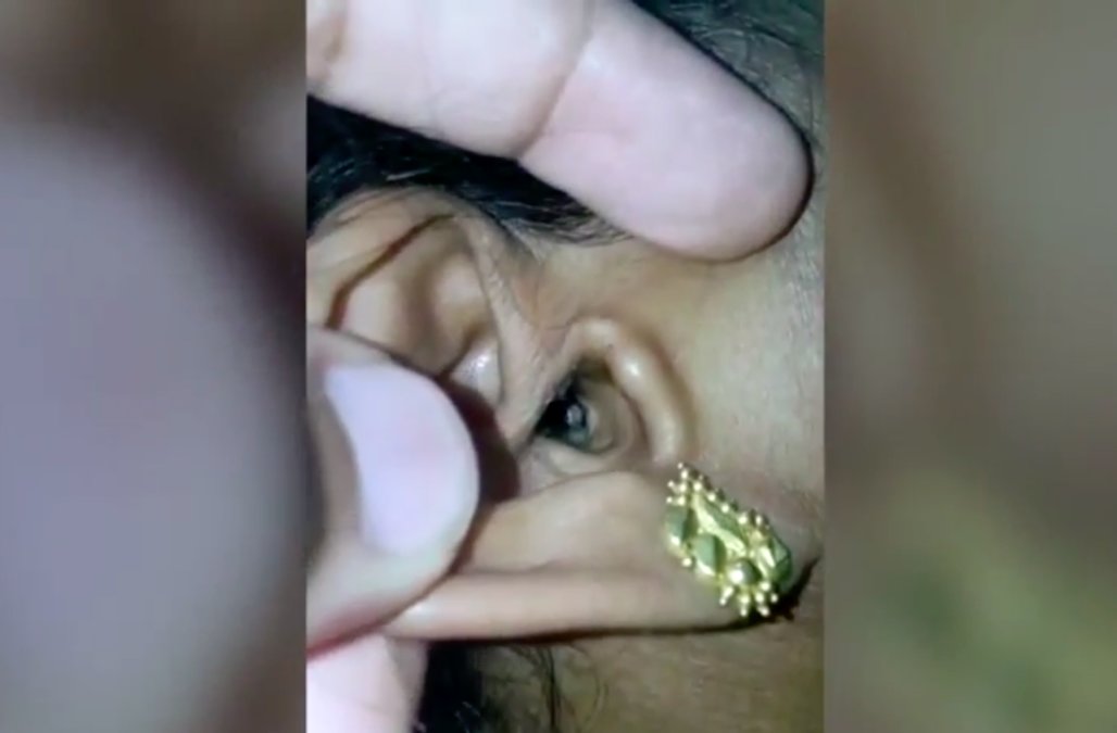 Woman Found That A Spider Living In Her Ear Is The Reason Behind Her Headaches