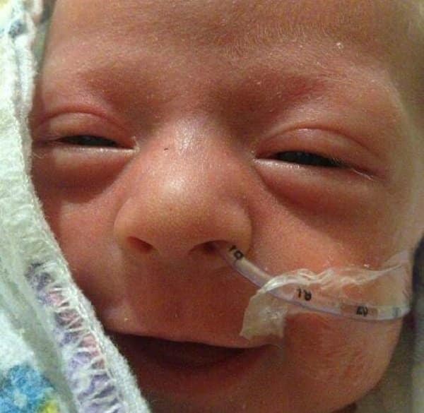 Smiling Photos Of Premature Babies
