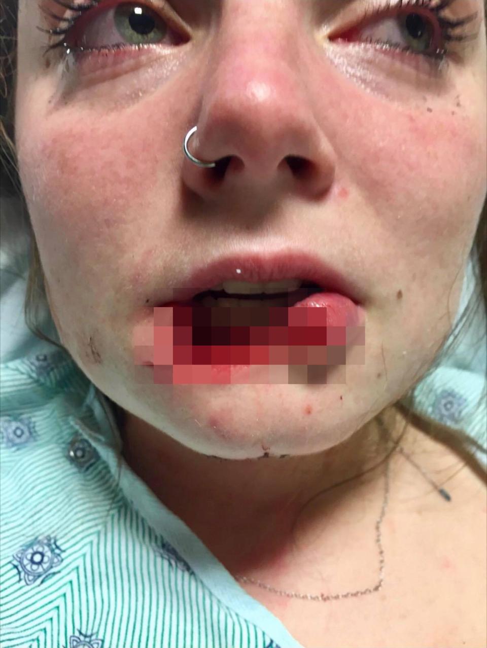 This girl's Ex Boyfriend Tore Her Lips Off Because He Wanted To Leave His Mark On Her For Her Next Boyfriend