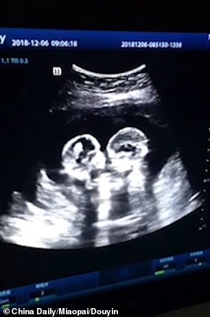 Identical Twins Found Fighting In The Mother's Womb During An Ultrasound Scan