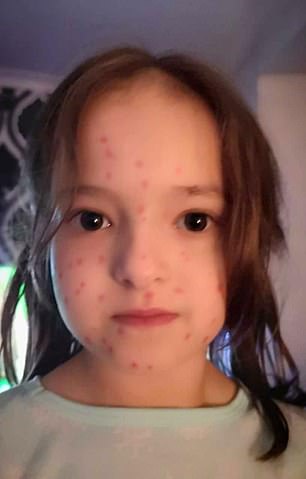 schoolgirl faked chickenpox to avoid school but it turned to be a permanent marker she used to draw spots