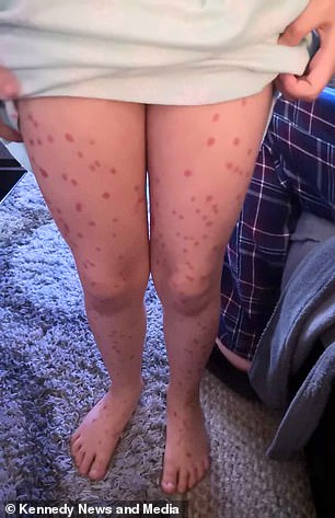 schoolgirl faked chickenpox to avoid school but it turned to be a permanent marker she used to draw spots