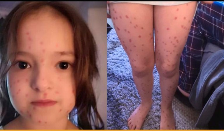 Schoolgirl Faked Chickenpox To Avoid School But Mistakenly Used Permanent Marker To Draw Spots