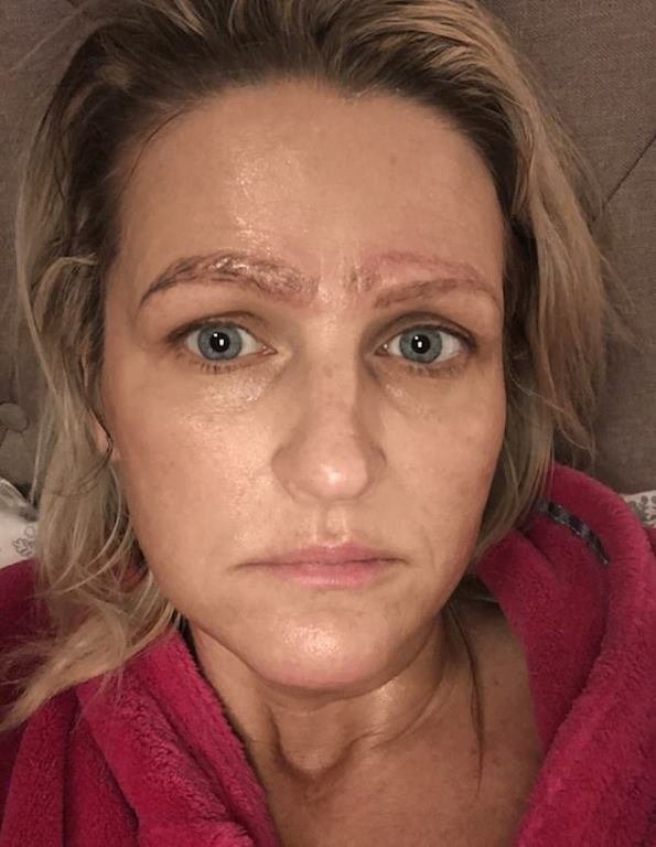 Woman Left With Four Eyebrows After Botched Treatment; Later Got Dumped by boyfriend