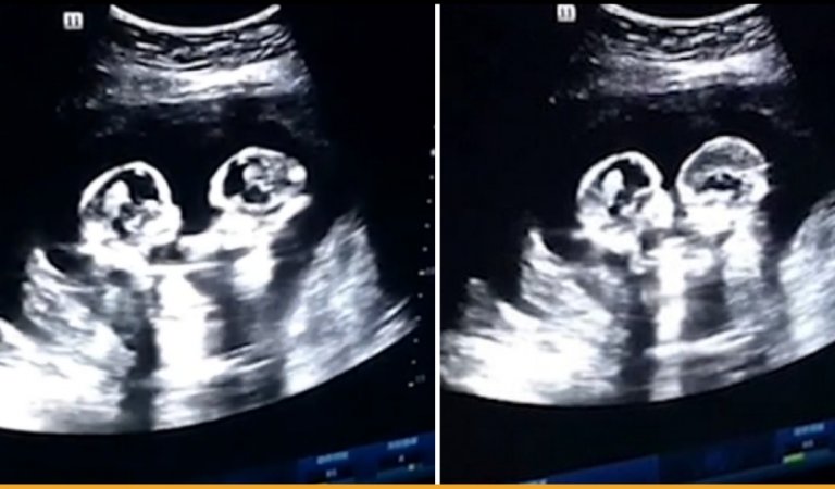 Identical Twins Found Fighting In The Mother’s Womb During An Ultrasound Scan