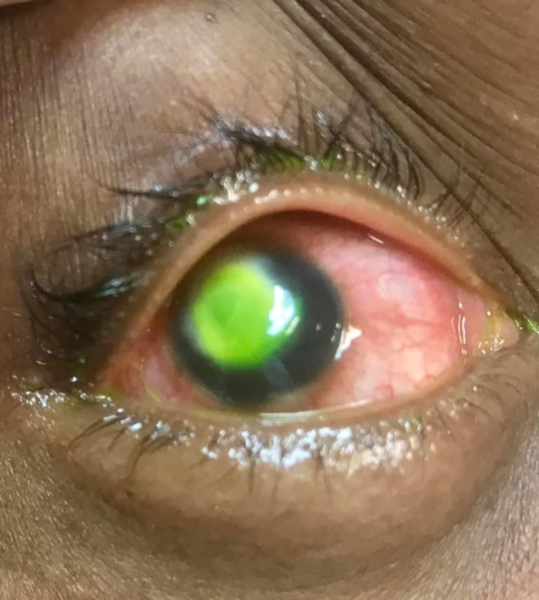 Woman’s Cornea Eaten Away By Bacteria After Sleeping In Contact Lenses