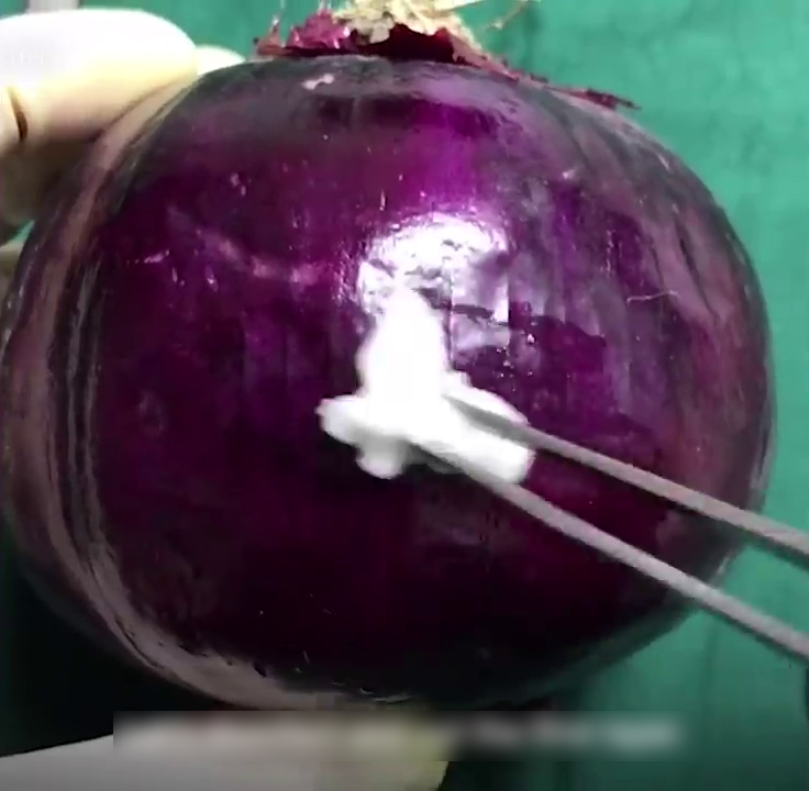 Onion Used To Demonstrate C- Section Surgery And People Are Respecting Those Women Who Went Through This Even More