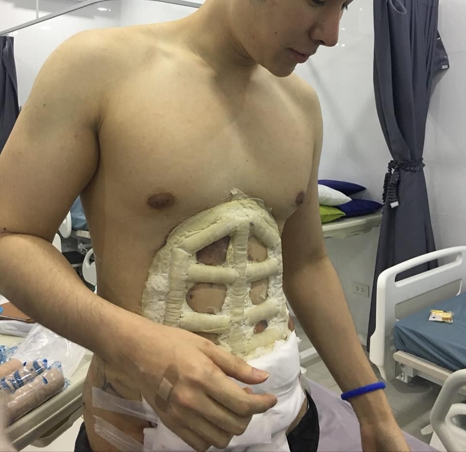 Hospital Offers Instant Six-Pack Abs With The Help Of Surgery!