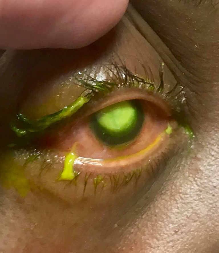 Woman’s Cornea Eaten Away By Bacteria After Sleeping In Contact Lenses