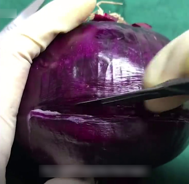 Onion Used To Demonstrate C- Section Surgery And People Are Respecting Those Women Who Went Through This Even More