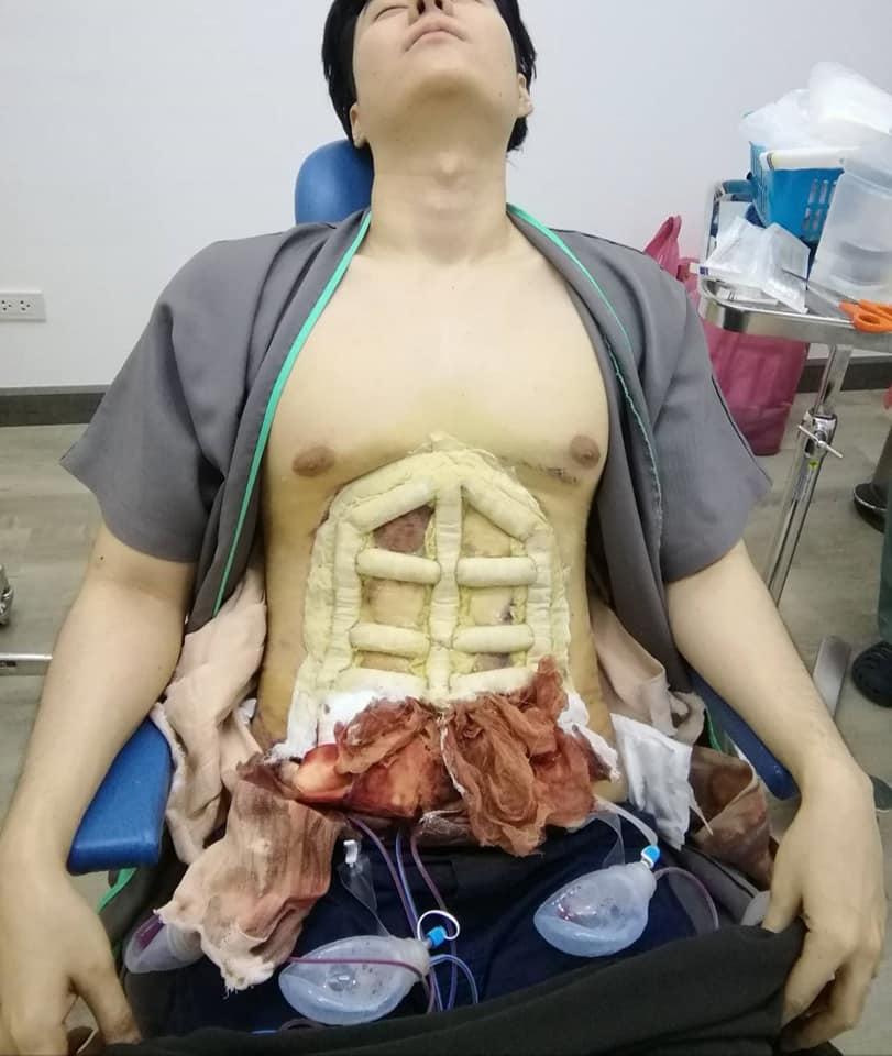 Hospital Offers Instant Six-Pack Abs With The Help Of Surgery!