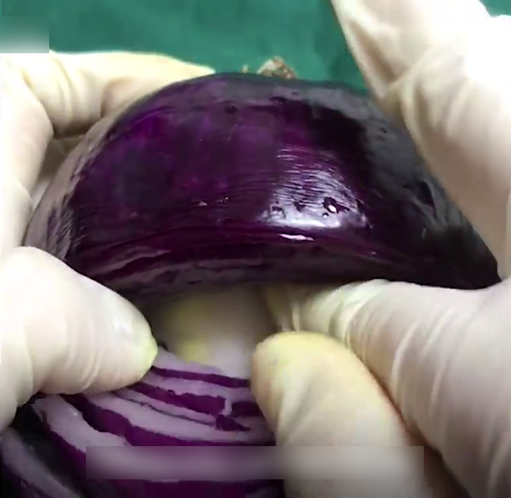 Onion Used To Demonstrate C- Section Surgery And People Are Respecting Those Women Who Went Through This Even More