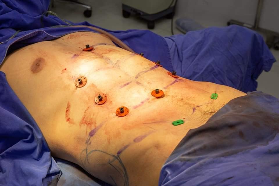 Hospital Offers Instant Six-Pack Abs With The Help Of Surgery!