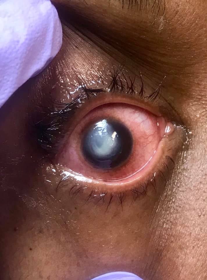 Woman’s Cornea Eaten Away By Bacteria After Sleeping In Contact Lenses