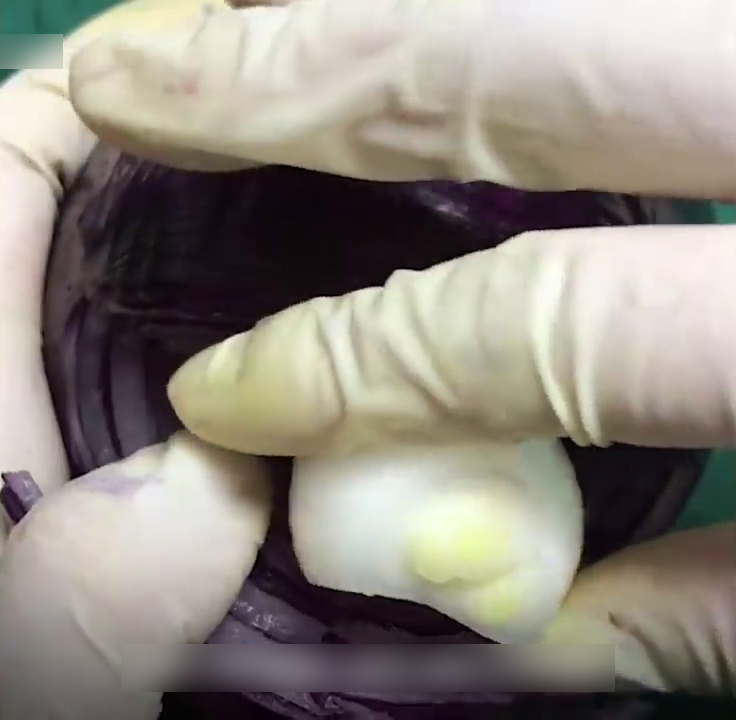 Onion Used To Demonstrate C- Section Surgery And People Are Respecting Those Women Who Went Through This Even More