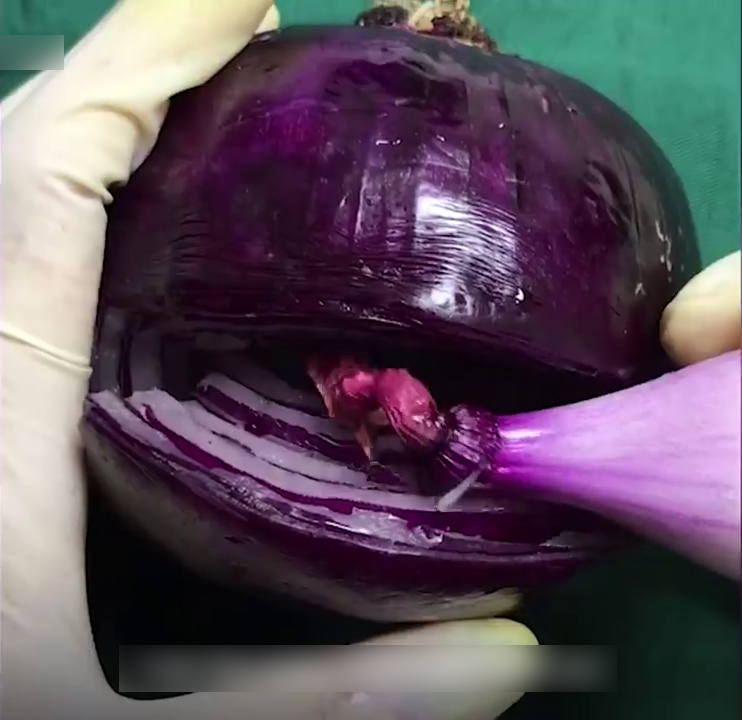 Onion Used To Demonstrate C- Section Surgery And People Are Respecting Those Women Who Went Through This Even More