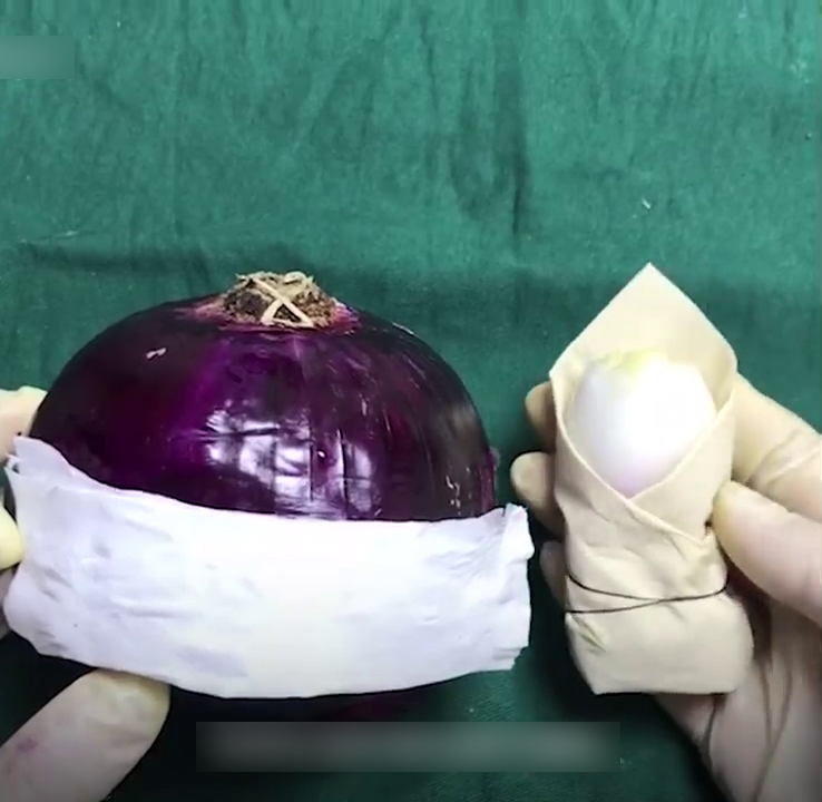 Onion Used To Demonstrate C- Section Surgery And People Are Respecting Those Women Who Went Through This Even More