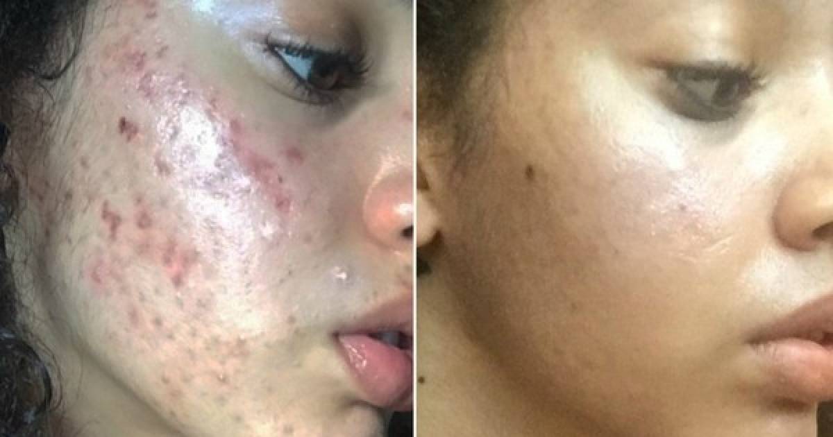 Top Household Products That Cured A Model's Acne