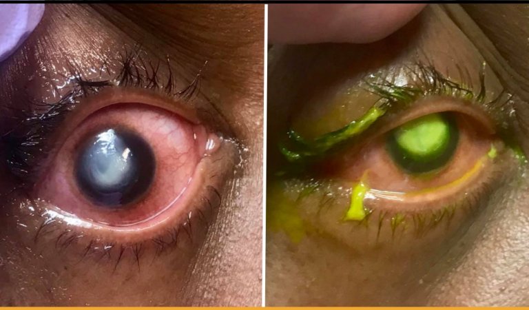 Woman’s Cornea Eaten Away By Bacteria After Sleeping In Contact Lenses