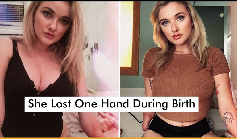 Model Inspires People Who Lost One Hand During Birth And The Other One Is Deformed