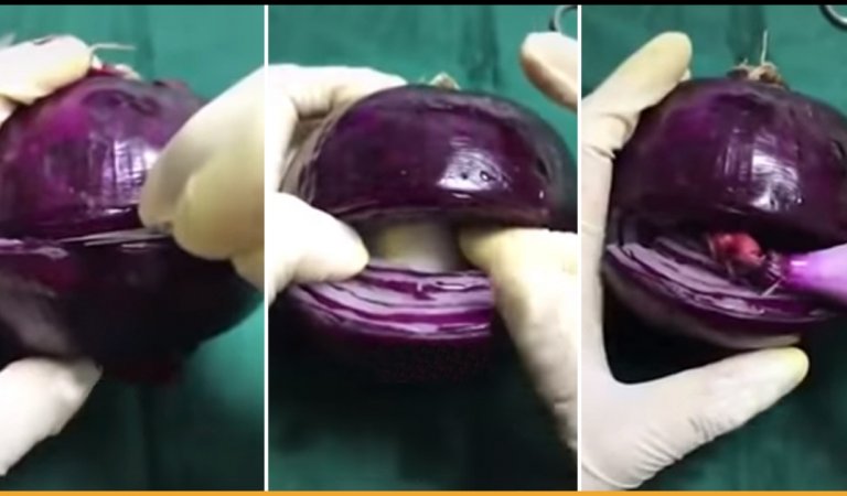 Onion Used To Demonstrate C-Section Surgery Will Make You Salute Women Who Goes Through It
