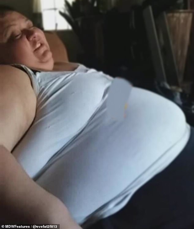 Obese Mother Had To Lose 325Lbs To Undergo Brain Surgery In Less Than 3 Years