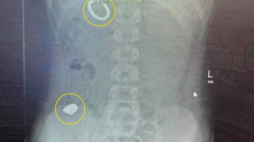 Boy Swallowed 54 Undergoes Operation 