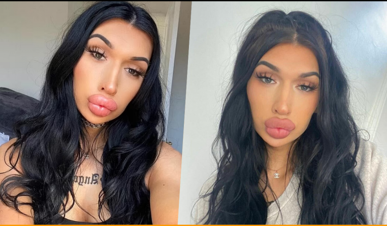 22 Years Old Woman Is Confident Having More Than £1,000 Lip Fillers Says Her Sugar Daddy Pays For The Procedure