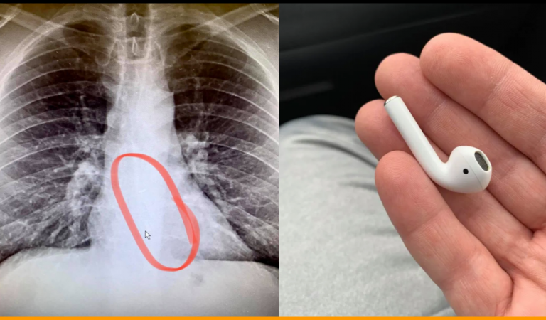Man Had To Undergo Endoscopy to Remove Airpod That He Swallowed While Sleeping