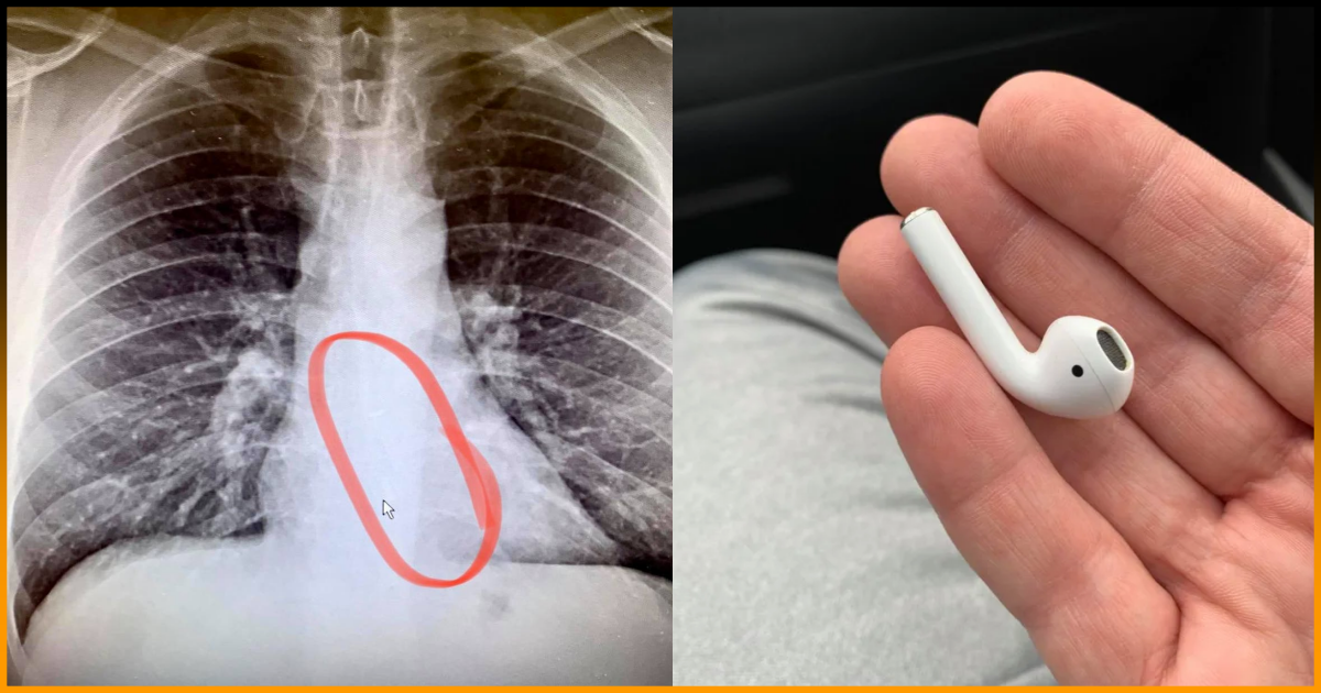 Man Had To Undergo Endoscopy to Remove Airpod That He Swallowed While
